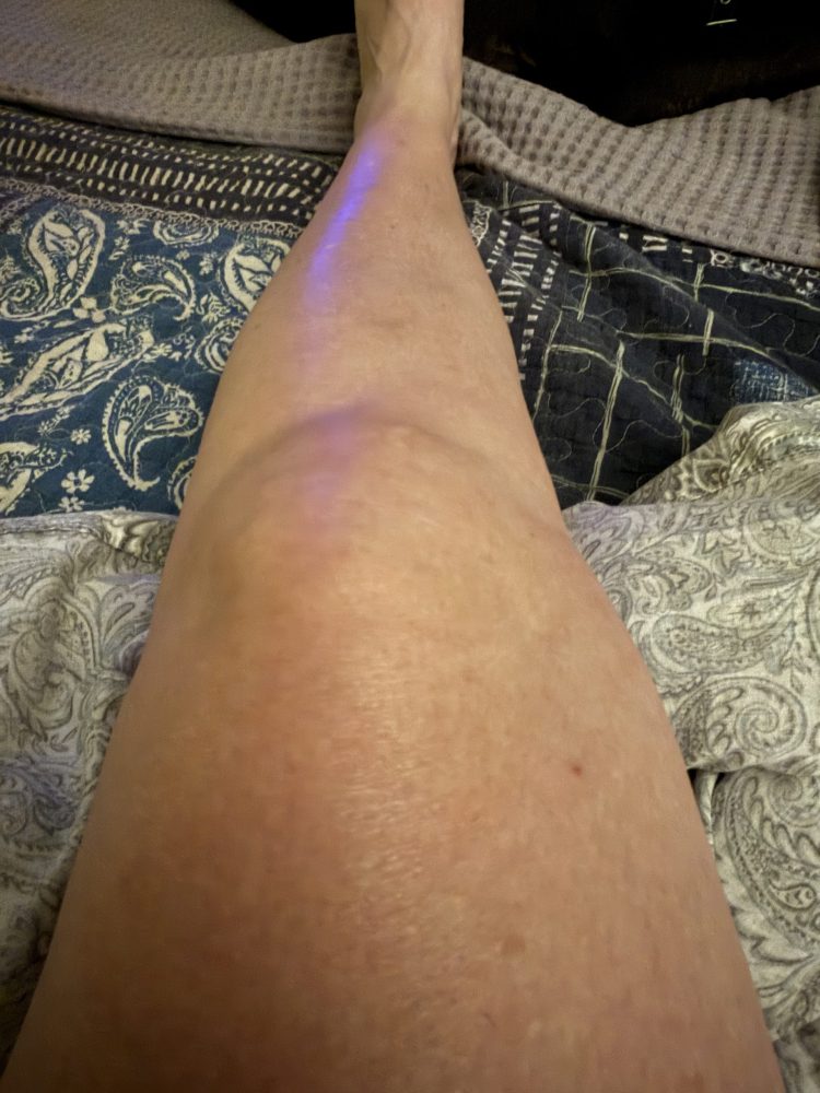 What are the Signs of a Worsening Meniscus Tear?